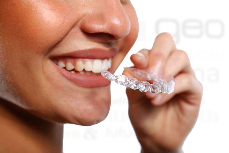 Invisalign l'ortodonzia invisibile
