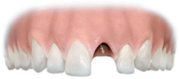 sostituzione di un singolo dente con un impianto di titanio