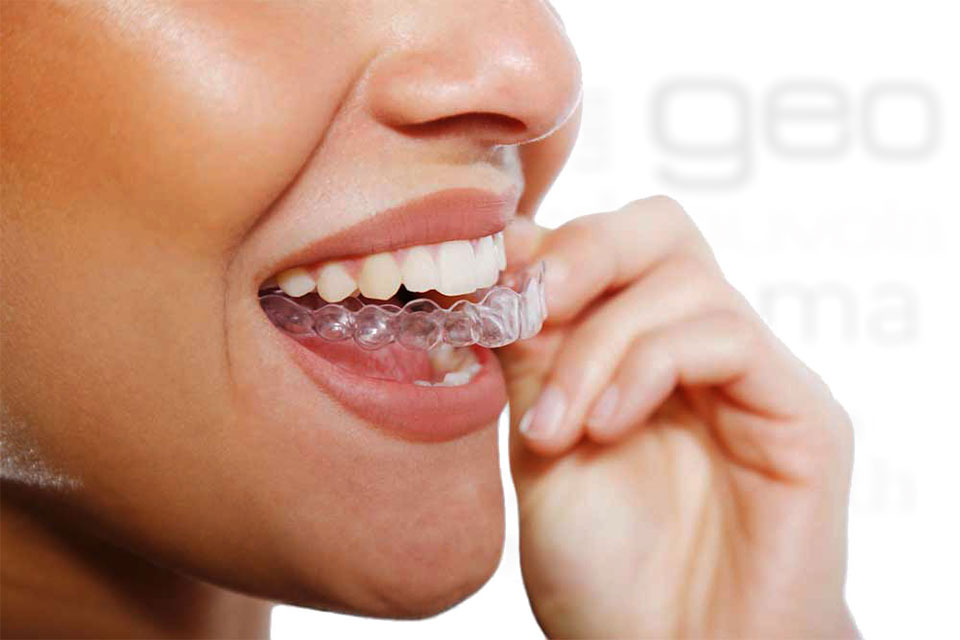 Invisalign l'ortodonzia invisibile