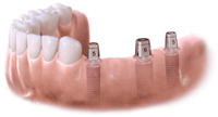 sostituzione di più denti con un impianti di titanio