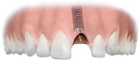 sostituzione di un singolo dente con un impianto di titanio