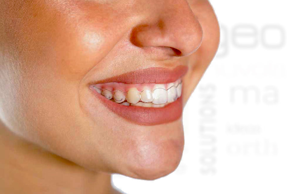 Invisalign l'ortodonzia invisibile