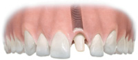 sostituzione di un singolo dente con un impianto di titanio