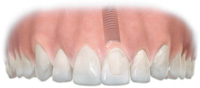 sostituzione di un singolo dente con un impianto di titanio