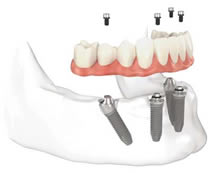 sostituzione di tutti i denti con impianti in titanio