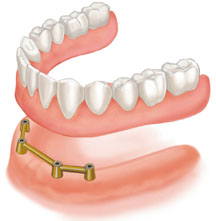 sostituzione di di tutti i denti con impianti in titanio