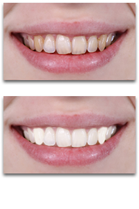 denti bianchi subito