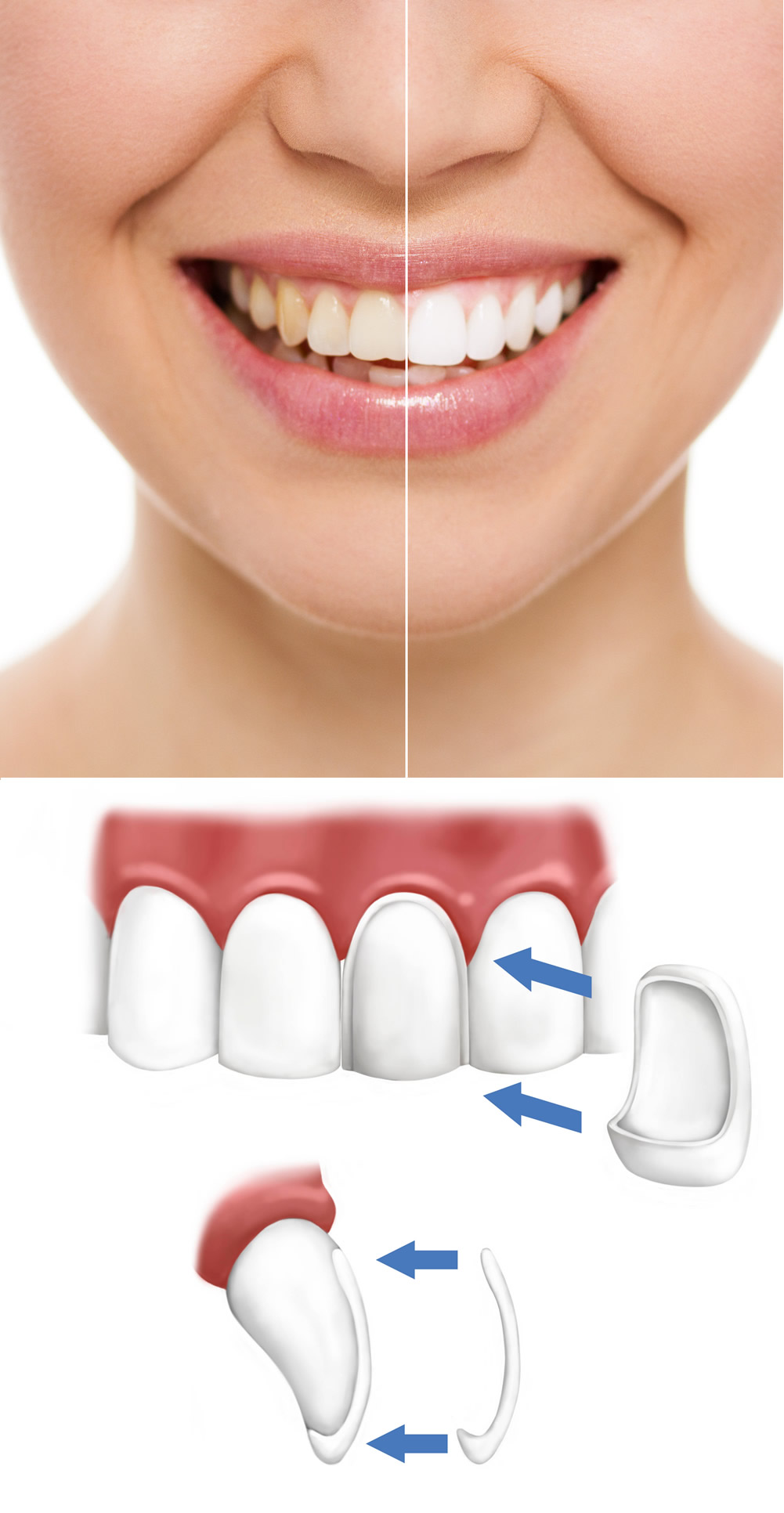 faccette dentali in ceramica