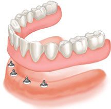 sostituzione di tutti i denti con impianti in titanio