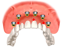 sostituzione di tutti i denti con impianti in titanio