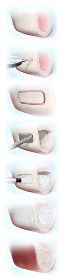 procedura sinus-lifting