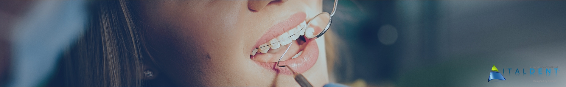 Clinica Odontoiatrica Italdent, Sbiancamento dei denti naturali