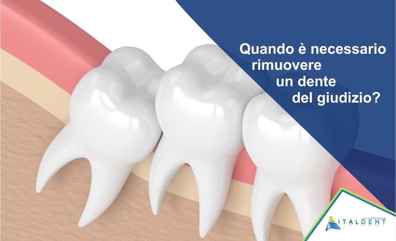 Quando è necessario rimuovere un dente (molare) del giudizio?