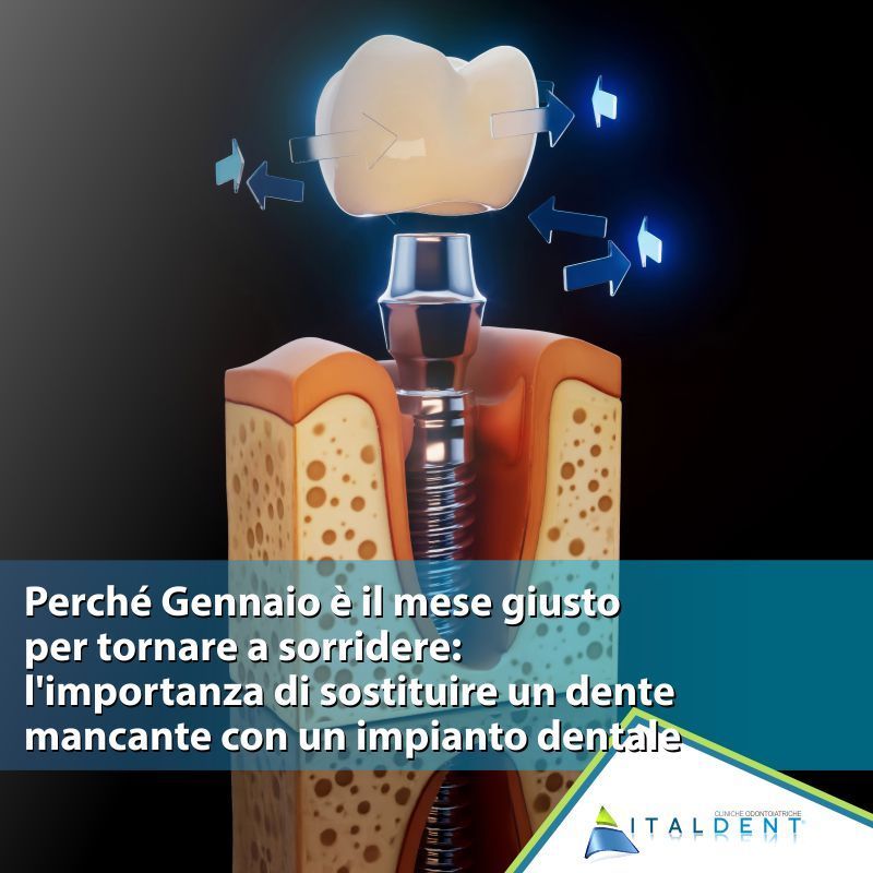 Perché Gennaio è il mese giusto per tornare a sorridere: l'importanza di sostituire un dente mancante con un impianto dentale