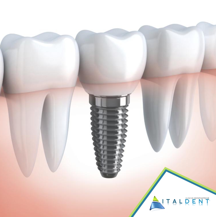 Implantologia Dentale