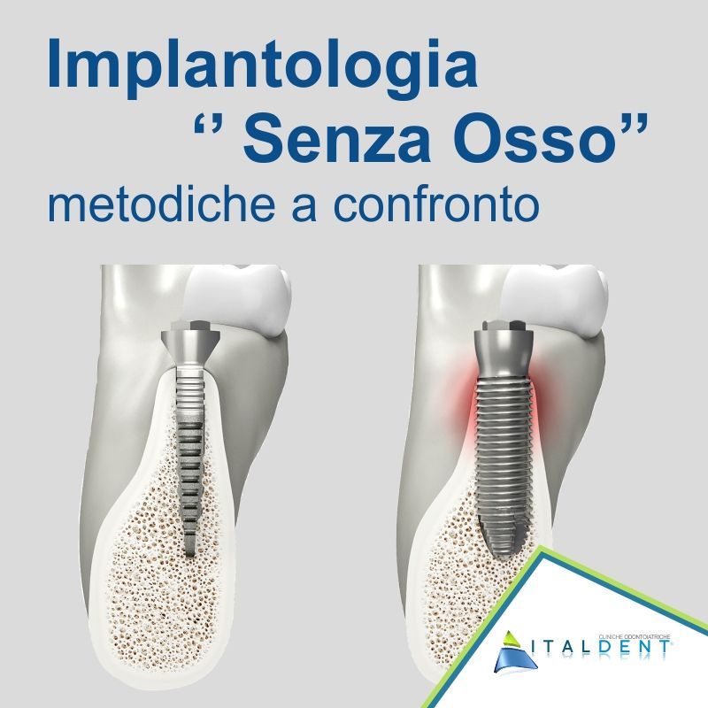 Implantologia senza osso, metodiche a confronto