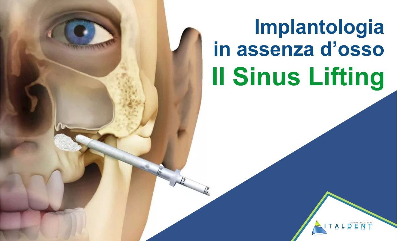 Implantologia senza osso, il Sinus Lifting