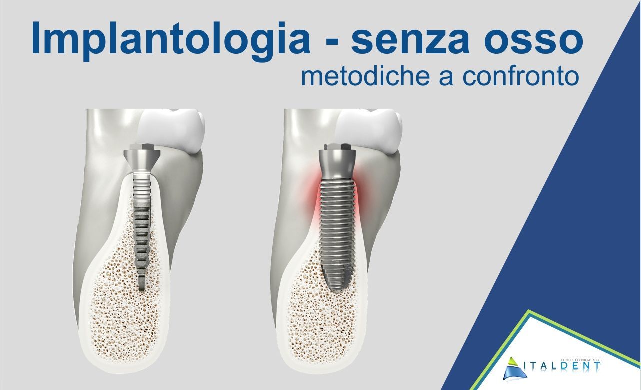 Implantologia senza osso, metodiche a confronto