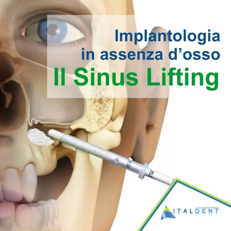 Implantologia senza osso, il Sinus Lifting