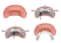 implantologia dentale computer assistita