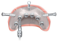 implantologia dentale senza bisturi
