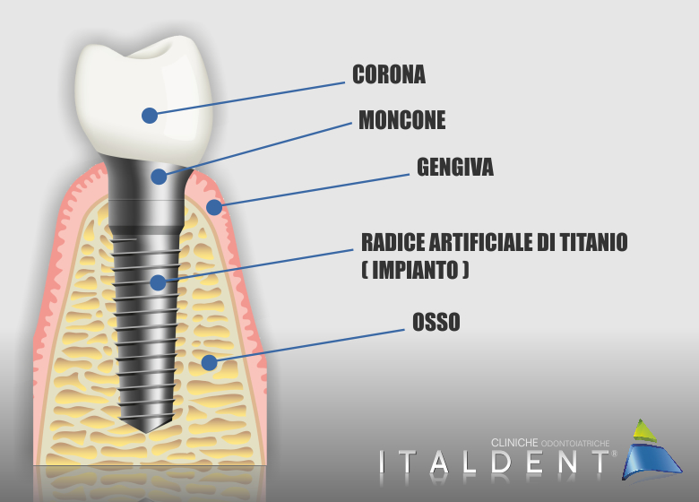 sostituzione di più denti con un impianti di titanio