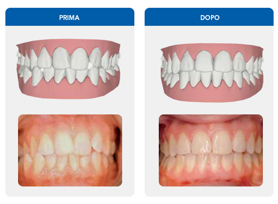 Invisalign l'ortodonzia invisibile