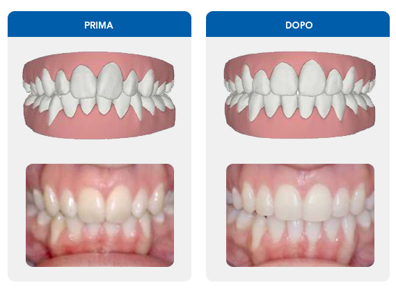 Invisalign l'ortodonzia invisibile