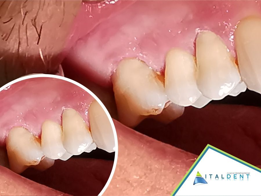 Ricostruzione in composito dei tessuti duri del dente