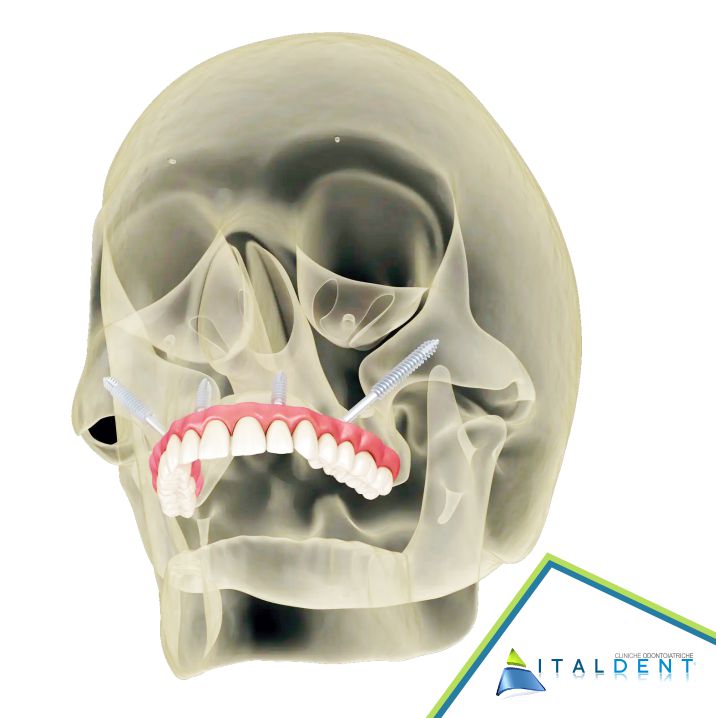 impianti zigomatici dentista a palermo