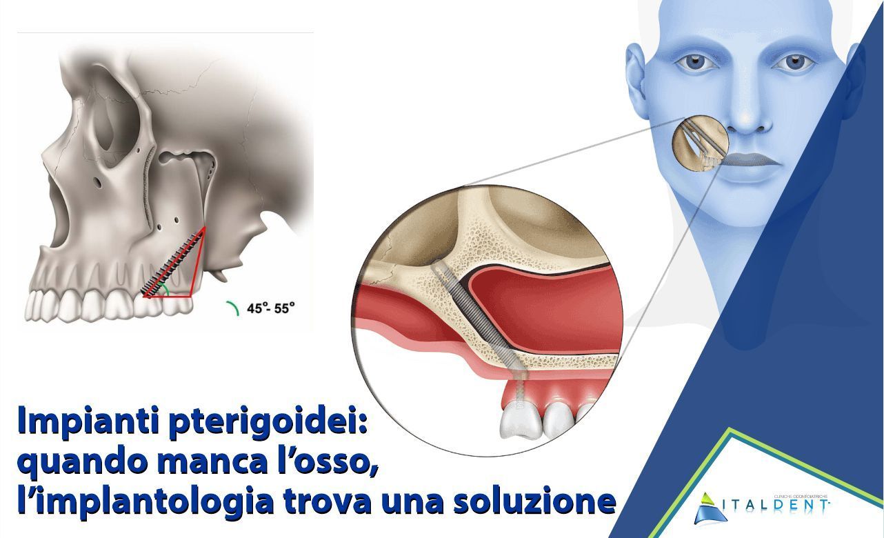 Impianti pterigoidei a Palermo: quando manca l’osso, l’implantologia trova una soluzione