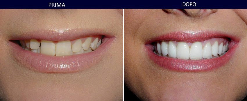 Faccette dentali dentista Palermo