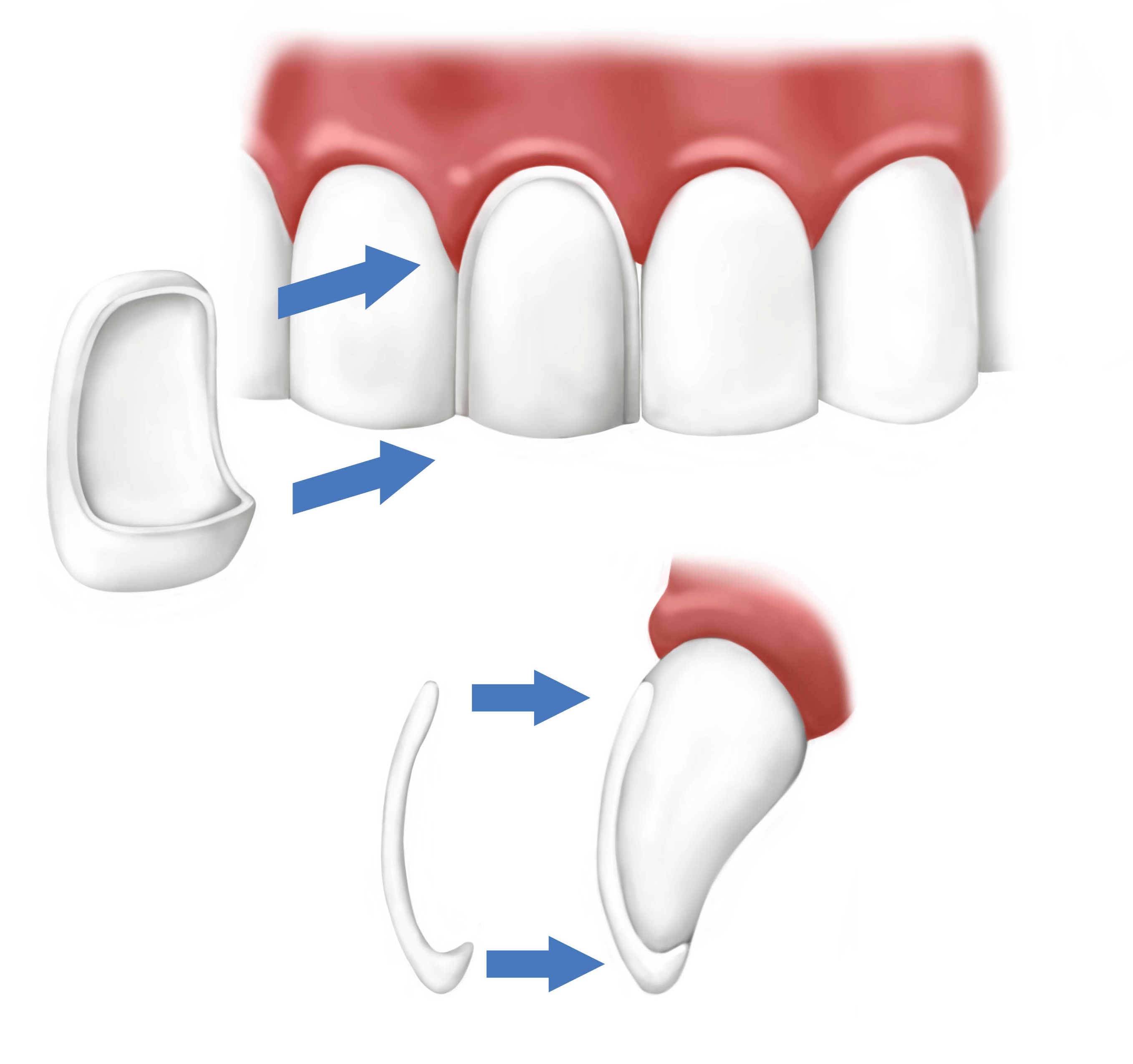 Faccette dentali dentista Palermo