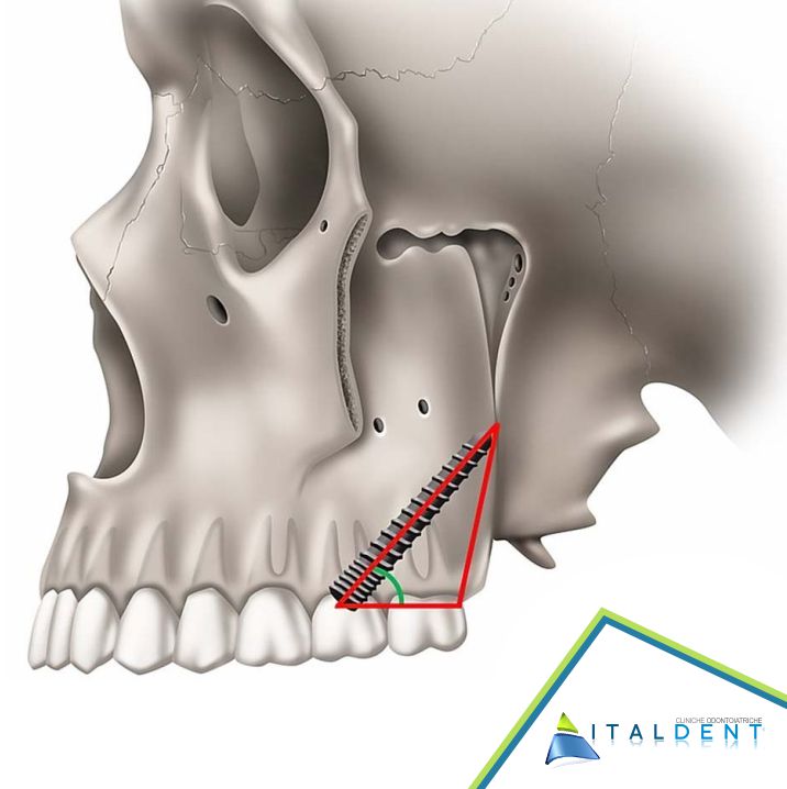 impianti pterigoidei dentista a palermo