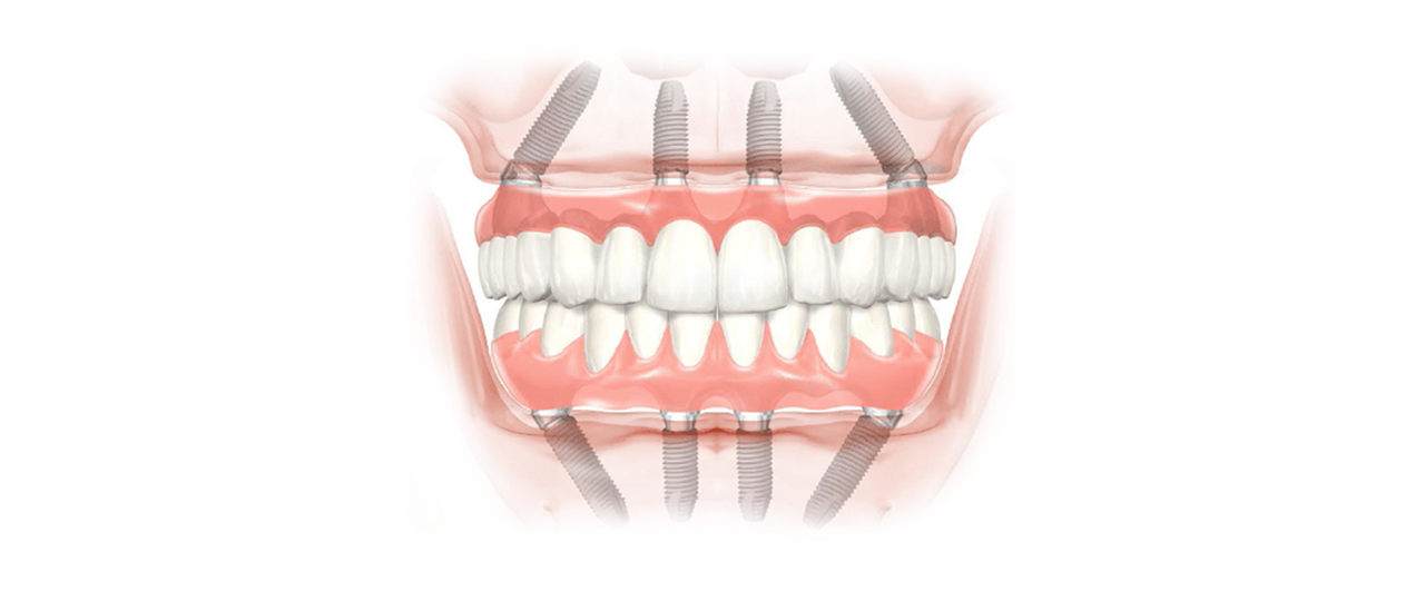 Implantologia senza osso, dentista specializzato a Palermo