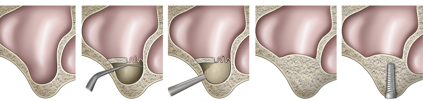 Sinus Lifting, tecnica per il rialzo del seno mascelalre, dentista Palermo