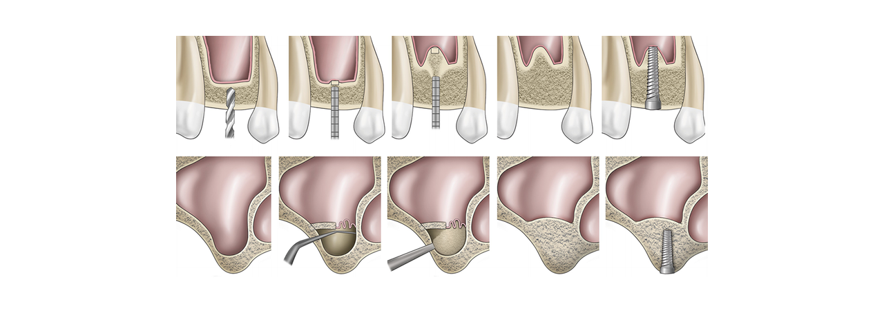 Sinus Lifting, tecnica per il rialzo del seno mascellare, implantologia Palermo